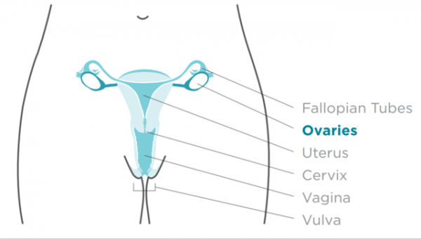 Cancerul ovarian este o afectiune grava